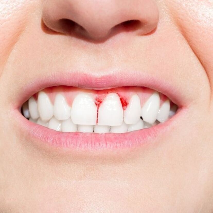 O que significa sonhar com dente sangrando? Quebrado, podre e mais