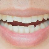 O que significa sonhar com dente furado? Na frente, no meio e mais! 