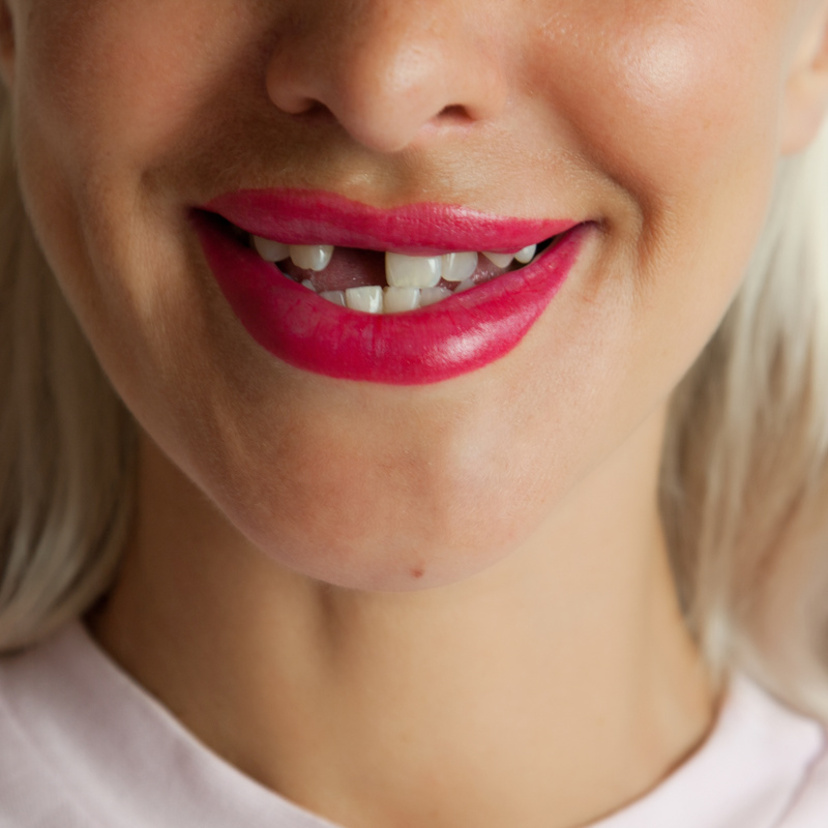 Sonhar que está banguela: sorriso, mãe, dentes caindo e mais!