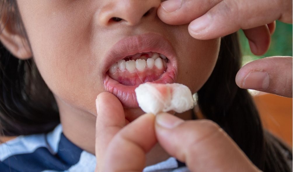 Criança com dente sangrando