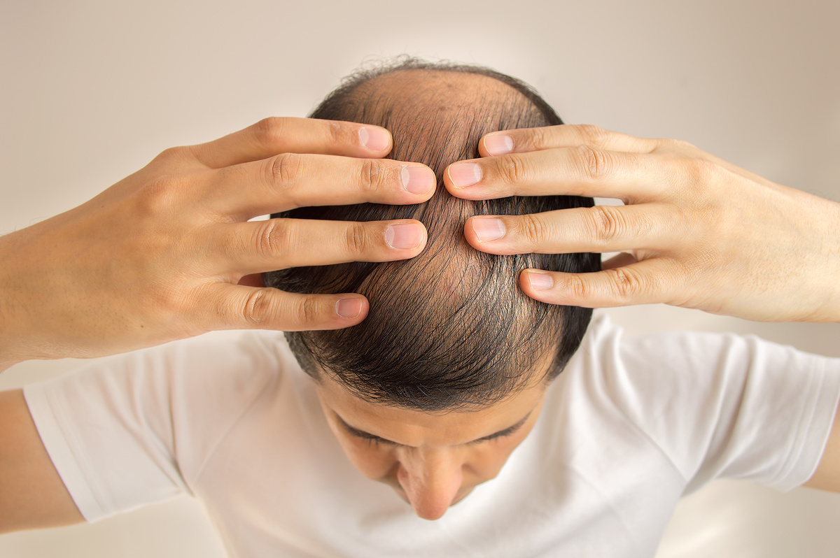 Homem ficando careca.