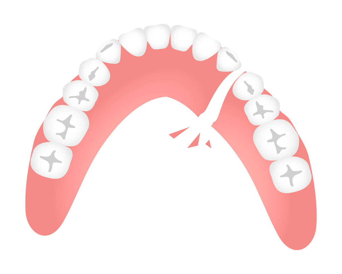 Desenho de uma dentadura quebrada.