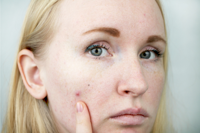 Mulher apontando para acne no rosto.